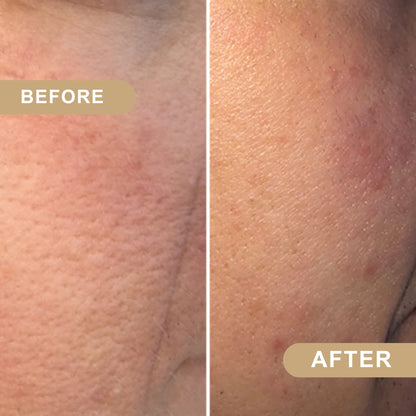 LumiBeauty | Peel Shot