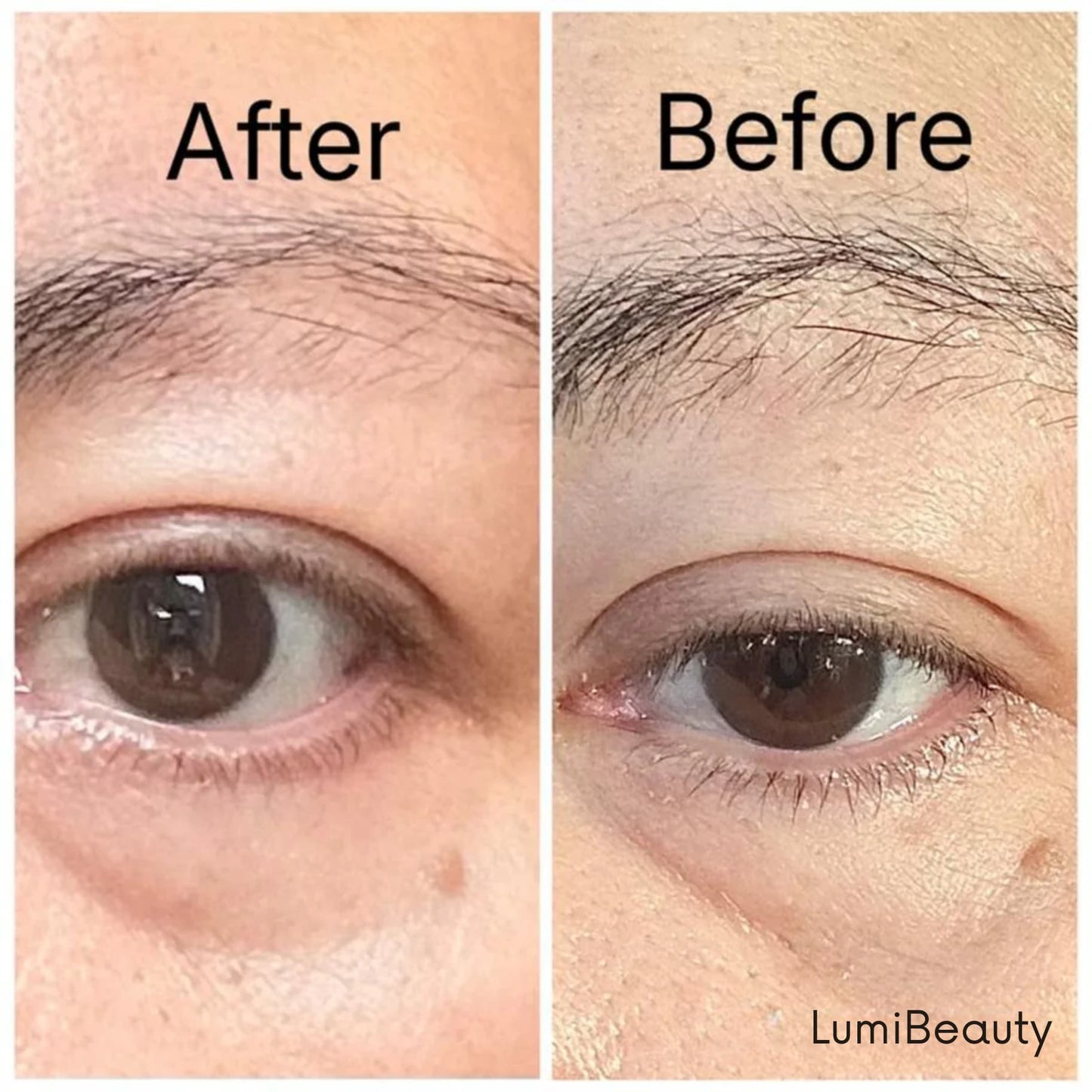 Temporary Eye Tightener