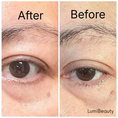 Temporary Eye Tightener