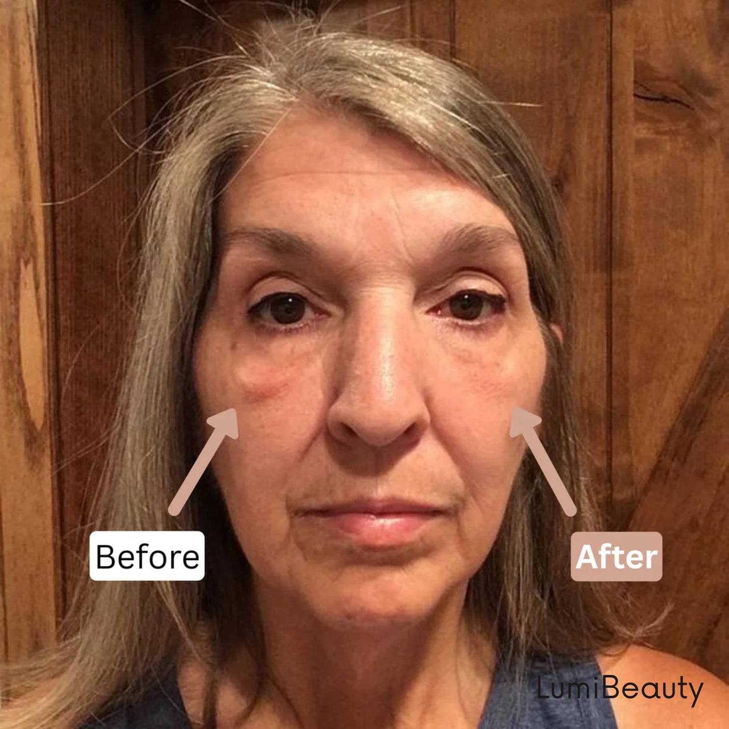 Temporary Eye Tightener