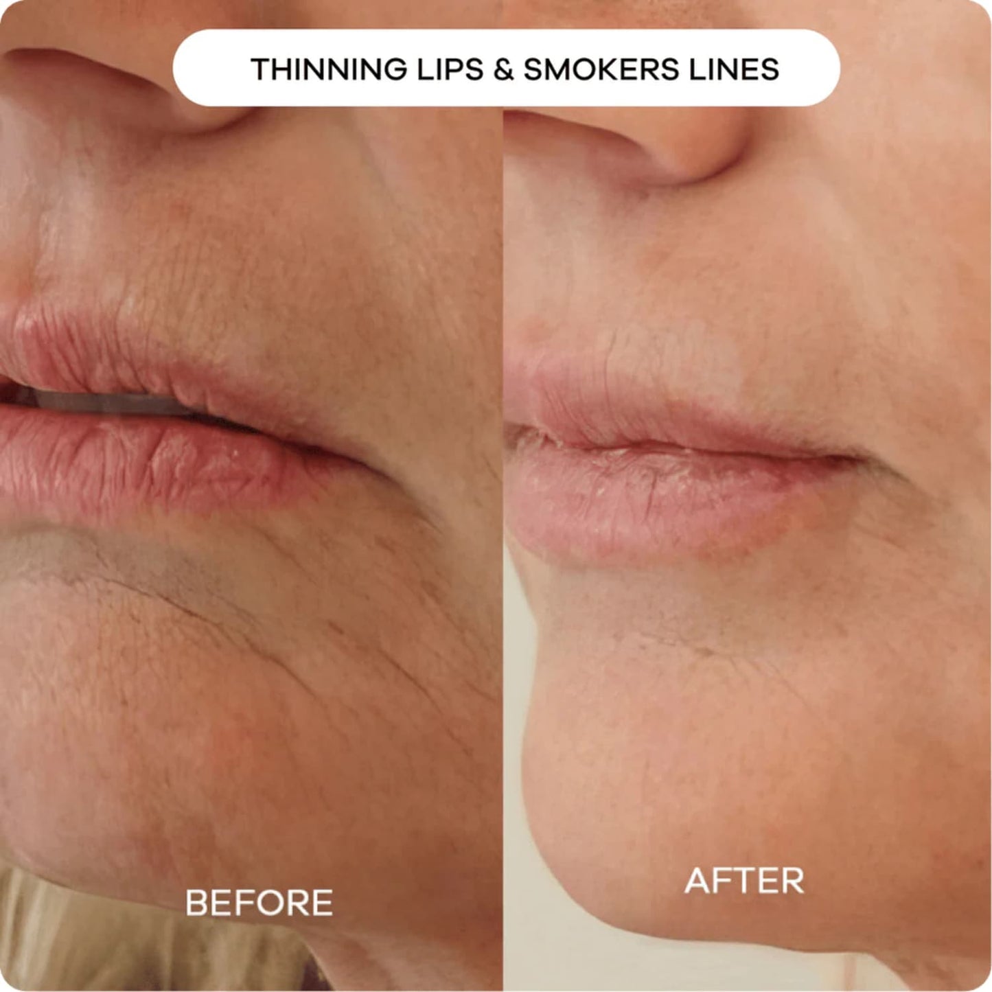 Rejuvenation Filler Serum